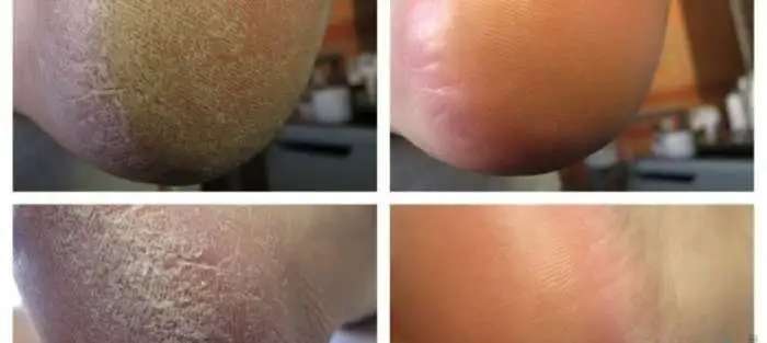 Медицинский аппаратный педикюр с выездом на дом.