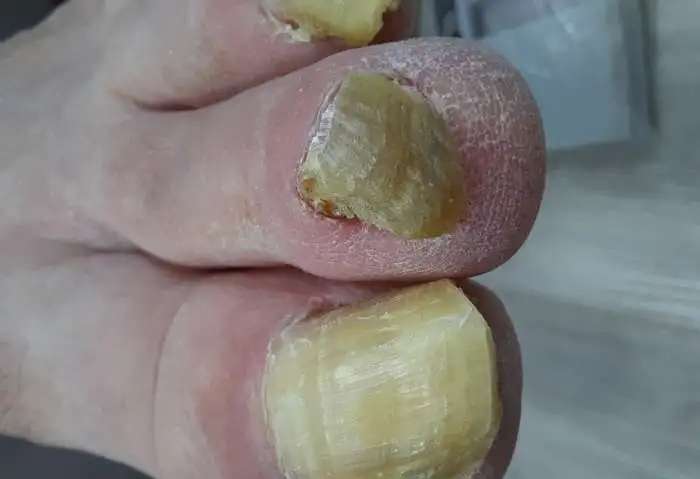 Медицинский педикюр. Подология.